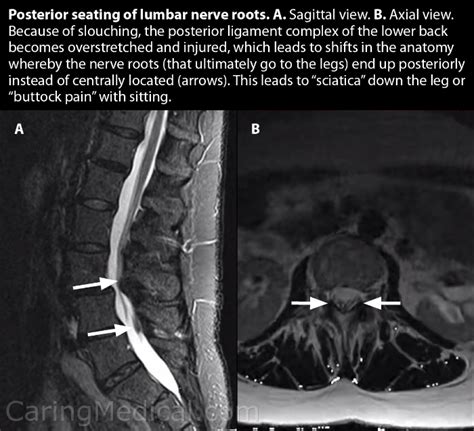 sciatica compression test|mri scan for sciatic nerves.